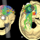Illustration for article titled What You Probably Don't Know About the Most Famous Case in Neuroscience